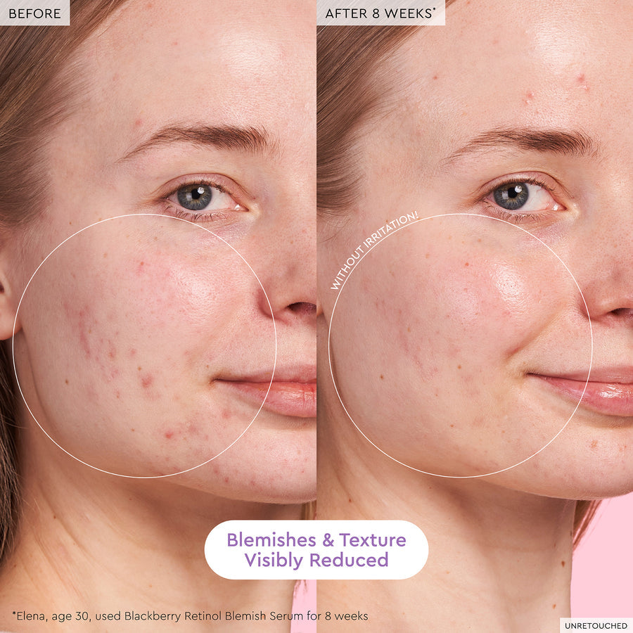 Blackberry Retinol Blemish Serum - Glow Recipe
