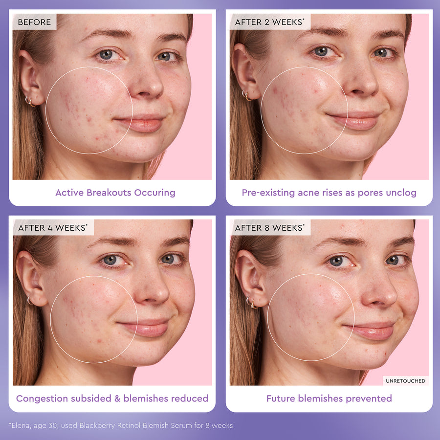 Blackberry Retinol Blemish Serum - Glow Recipe