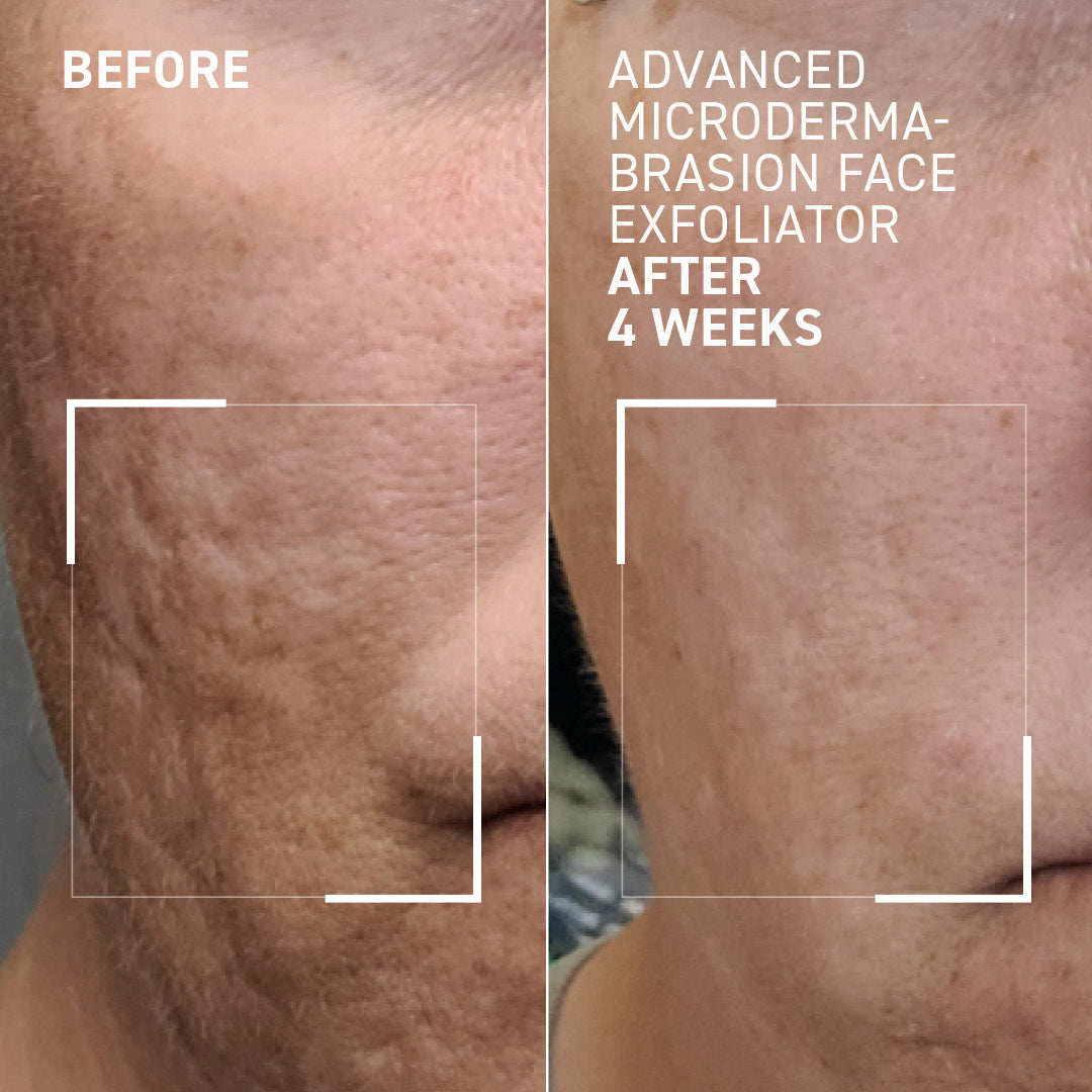 Advanced Micro Derma Brasion Face Exfoliator - Dr. Brandt