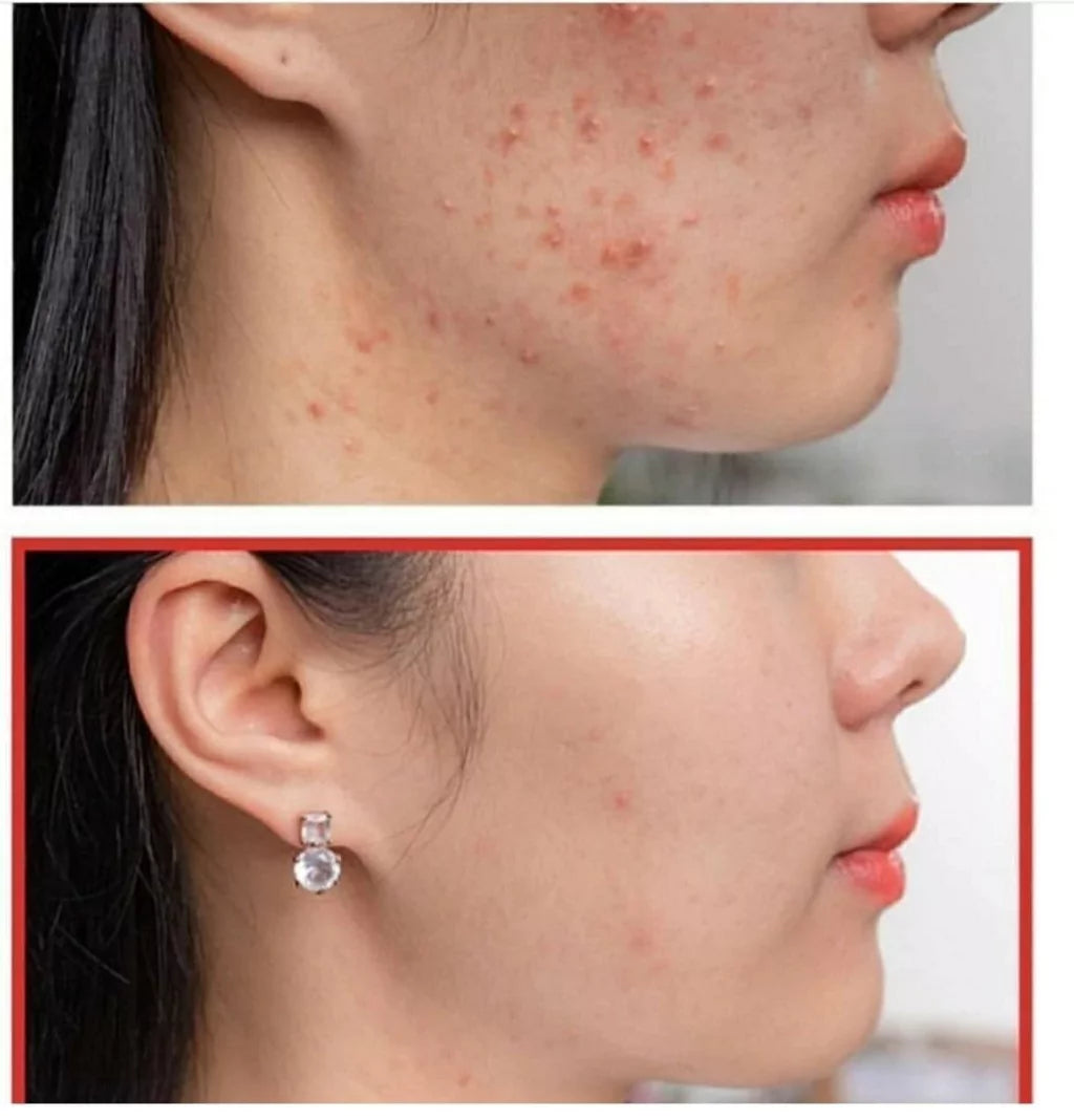 Super Miracle Spot all Kill cream - Some By Mi