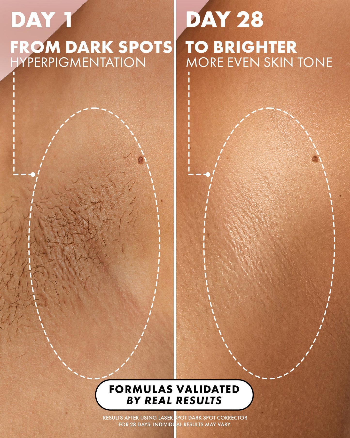 Laser Spot Dark Spot Treatment - Truly