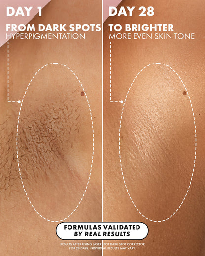 Laser Spot Dark Spot Treatment - Truly