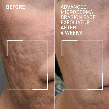 Advanced Micro Derma Brasion Face Exfoliator - Dr. Brandt
