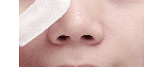 Exfoliating Pads - Apieu