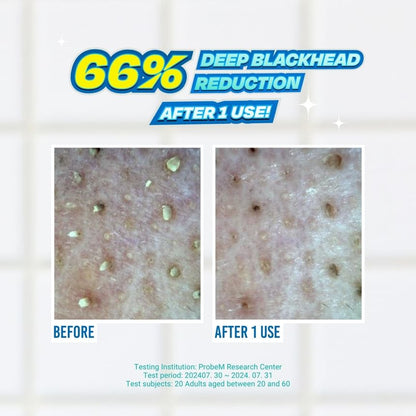Blackhead Melting Softener Special Kit - Jumiso