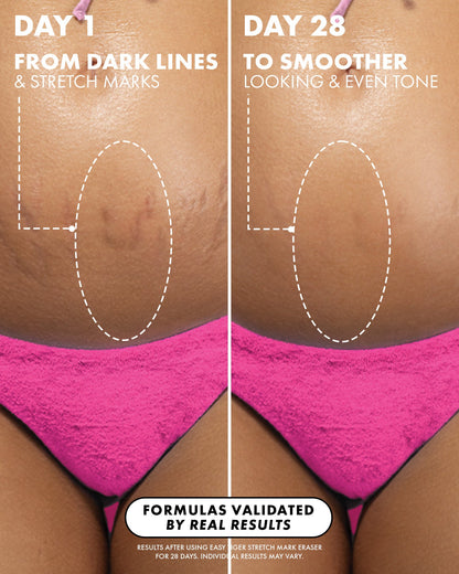 Easy Tiger Stretch Mark Eraser - Truly